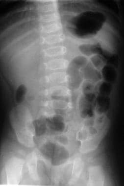 Abdominal radiograph shows small bowel dilatation 