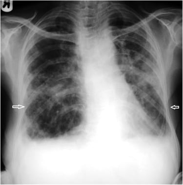 Bilateral aspiration pneumonia (white arrows) due 