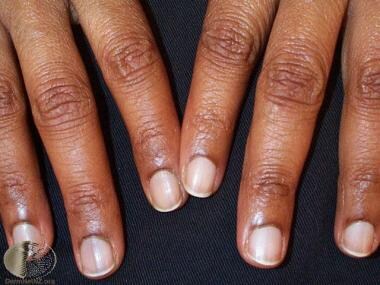 Nail findings in Laugier-Hunziker syndrome. Courte