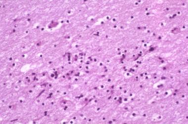 HIV-1 encephalopathy and HIV associated neurocogni