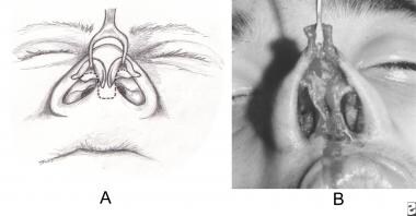 A. Nostril and columellar rim incision for complet