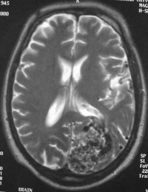 Arteriovenous malformation (AVM) of the brain. Axi
