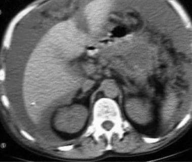 Enlarged porta hepatis lymph nodes, ascites, and o