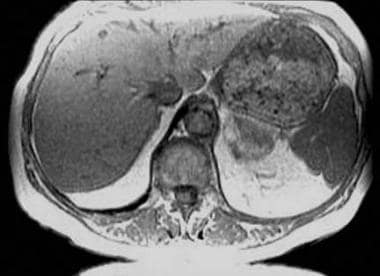 An 87-year-old woman with a left adrenal myelolipo