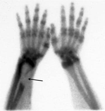 Technetium Tc 99m bone scan demonstrates a large a
