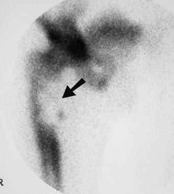 Localized isotopic bone scan in the same patient (