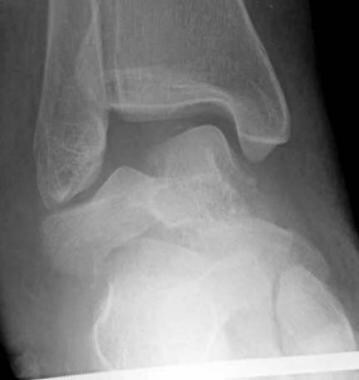 Talar body fracture, anteroposterior radiograph. T