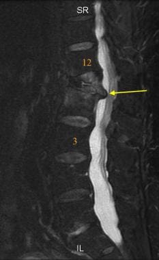 Sagittal FSE T2 weighted MRI of the lumbar spine. 