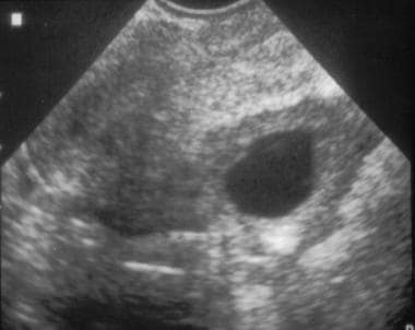 Can an ultrasound show the size of a cyst?