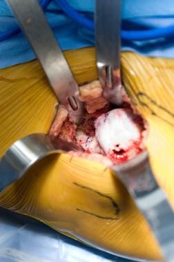 Minimally invasive total hip arthroplasty: direct