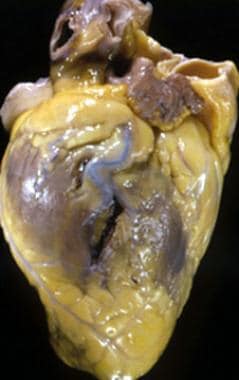 Myocardial Rupture. Photograph of the heart of 43-