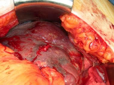 This patient has a splenic abscess due to pneumoco