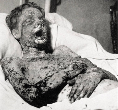This patient with smallpox survived toxemia to suc