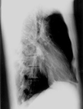 Mitral valve prolapse. A patient with straight bac