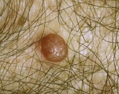 Molluscum contagiosum. Larger lesions may have sev