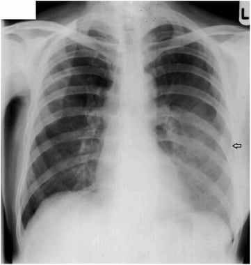 Left aspiration pneumonia (black arrow) due to an 