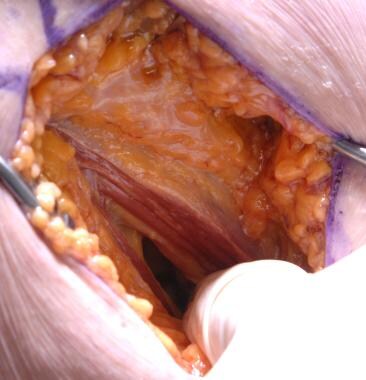 Minimally invasive total hip arthroplasty: direct