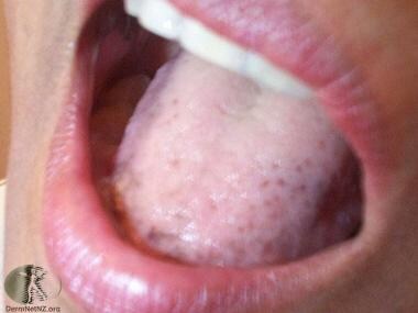 Oral findings in Laugier-Hunziker syndrome. Courte