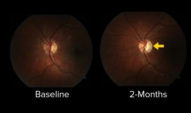 The evolution of temporal optic disc pallor (arrow