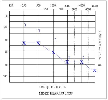 Audiogram depicting a mixed sloping hearing loss i
