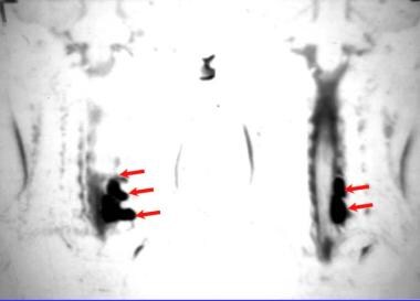 Magnetic resonance myelogram in a patient with a b