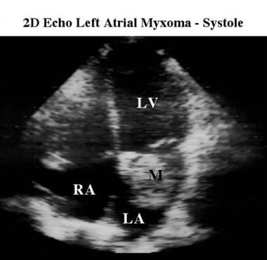 Apical 4-chamber 2-dimensional echocardiogram of a