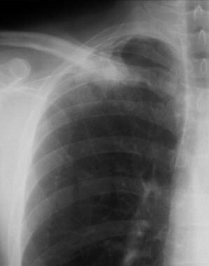 Solitary pulmonary nodule. Close-up chest radiogra