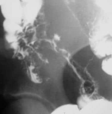 Crohn disease. Spot view of the terminal ileum fro
