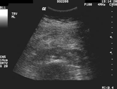 Transverse sonogram of the abdomen demonstrates a 