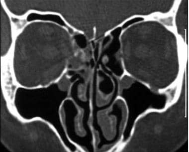 Coronal computed tomography scan shows a medial wa