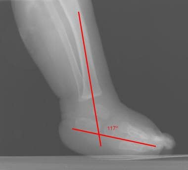 Lateral view in talipes equinovarus demonstrates a