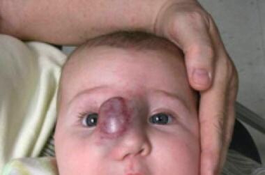 Superficial infantile hemangioma. 