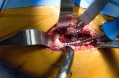 Minimally invasive total hip arthroplasty: direct