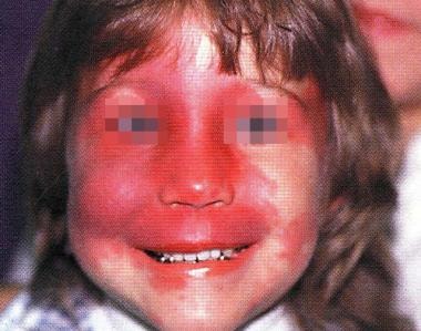 A child with Sturge-Weber syndrome with bilateral 