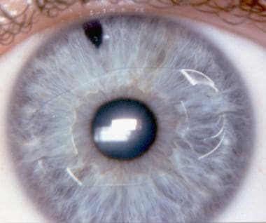 The iris claw lens for a phakic hyperopic eye, imp