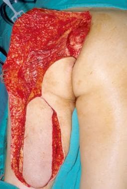 Posterior gluteal thigh flap undergoing elevation