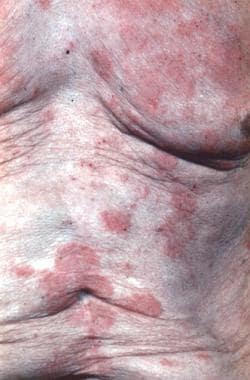 Patch-stage mycosis fungoides. 