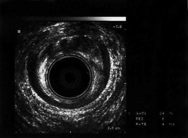 Fecal Incontinence Treatment & Management: Medical Therapy, Surgical 