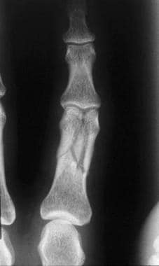 Phalangeal fractures. Complex unstable fracture of