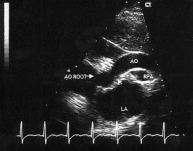 Two-dimensional suprasternal echocardiographic ima