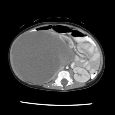 CT scan in a patient with a right-sided Wilms tumo