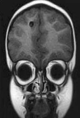 MRI of 6-year-old boy from Peru with single right