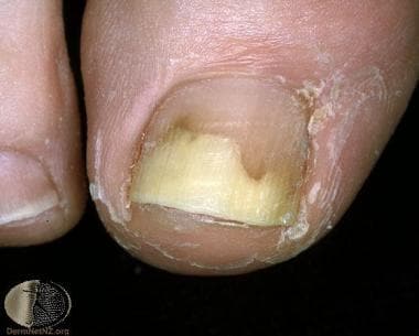Great toe onycholysis. Courtesy of Professor Raimo