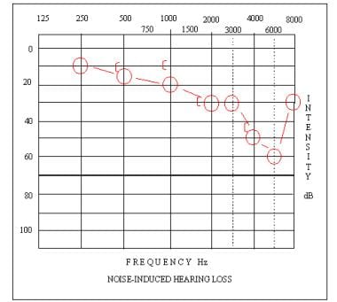 Audiogram depicting a high-frequency sensorineural