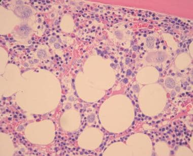 Pathology of therapy-related myeloid neoplasms. Bo