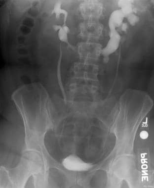 Intravenous urogram (IVU) of a male patient displa