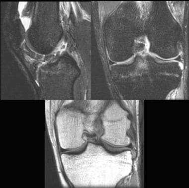 Primary signs of an ACL tear. Sagittal image (top 