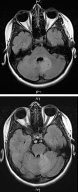MRI, T2-weighted images of brainstem involvement w