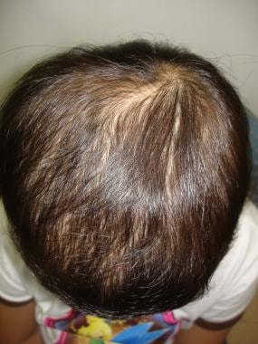Sometimes, alopecia is not circumscribed but simpl