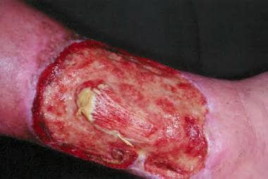 Classic, or typical, pyoderma gangrenosum. This pa
